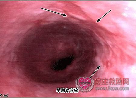 4)乳头状型或隆起型 肿瘤呈外生结节状隆起,乳头状或息肉状突人管腔