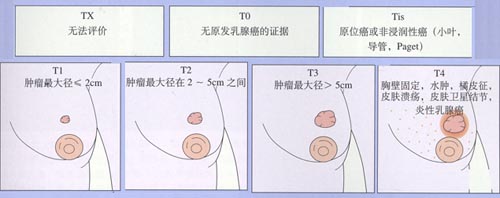 乳腺癌的分期