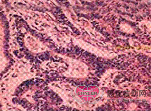 图见正常柱状上皮,上皮下为分化较好的腺癌组织.