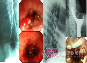 食管癌其他治疗方法